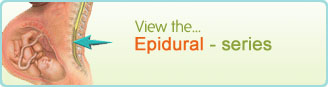 Epidural - series