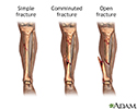 Bone fracture repair - series