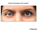 Ptosis - drooping of the eyelid