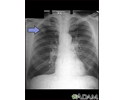 Adenocarcinoma - chest x-ray