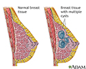 Fibrocystic breast change