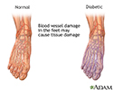 Diabetic blood circulation in foot