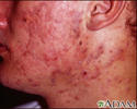 Acne - cystic on the face