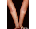 Dermatitis - atopic on the arms