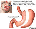 Gastric sleeve procedure