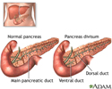Pancreas divisum