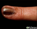 Skin cancer, melanoma on the fingernail