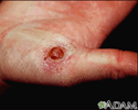 Pyogenic granuloma on the hand