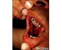 Pemphigus vulgaris - lesions in the mouth