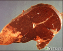 Hodgkin's disease - liver involvement