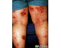 Dermatitis - atopic on the legs