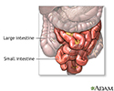 Small bowel resection - series