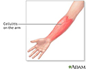 Cellulitis on the arm