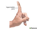 Hypermobile joints