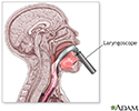 Laryngoscope