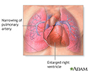 Primary pulmonary hypertension