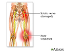 Sciatic nerve damage
