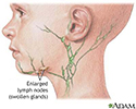 Swollen lymph node