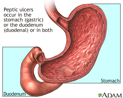 Location of peptic ulcers