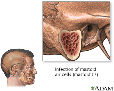Mastoiditis - Indications