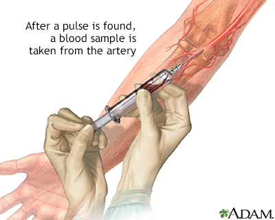 Arterial blood sample