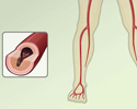 Peripheral artery disease (PAD) - overview 